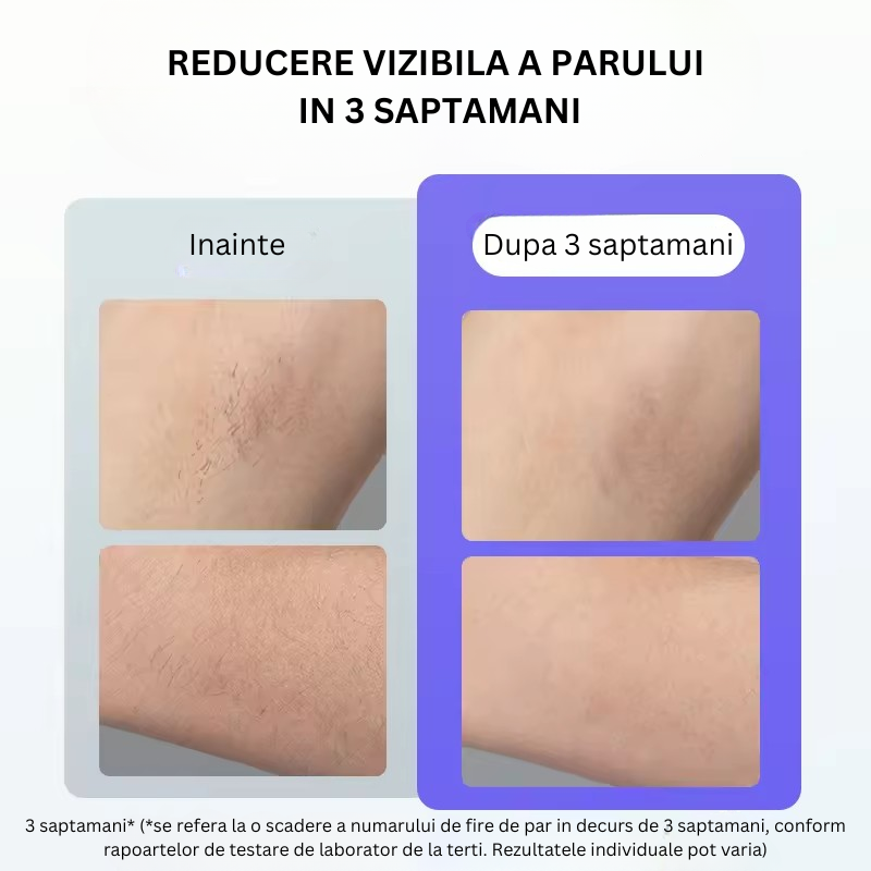 Epilator IPL 990.000 impulsuri, 5 trepte, 4 moduri, tehnologie Ice Cooling pentru epilare definitiva si rejuvenare