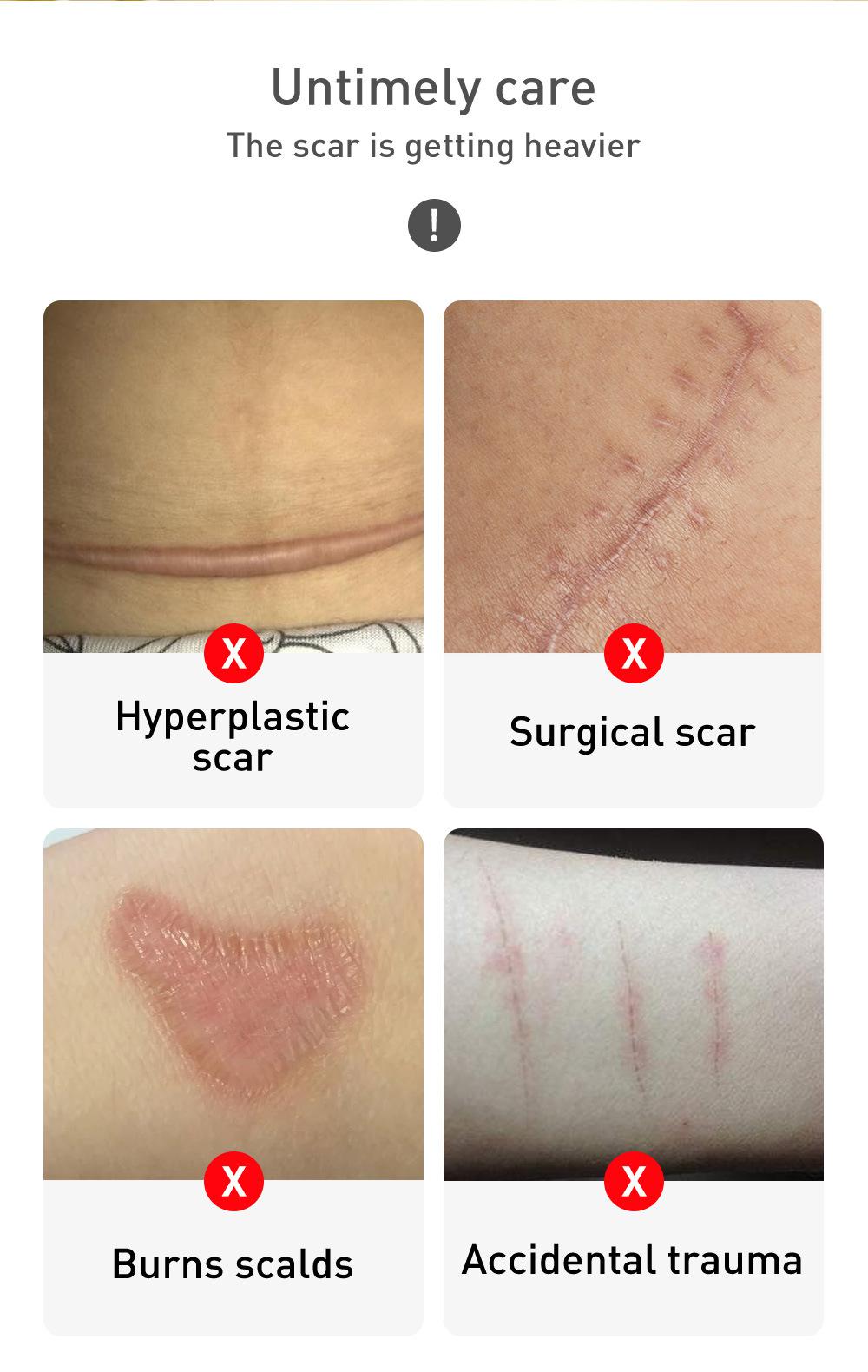 Crema pentru cicatrici, vergeturi, Lanbena