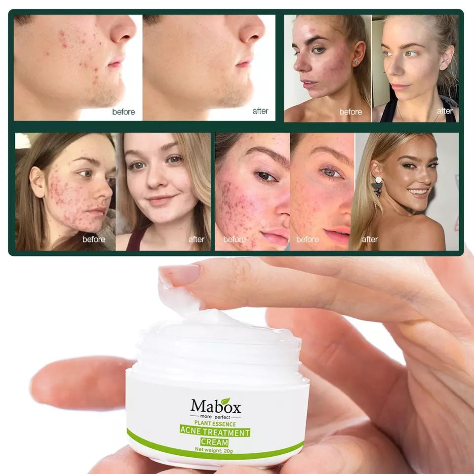 Crema hidratanta pentru tratamentul acneei, Mabox 20g, 100% naturala