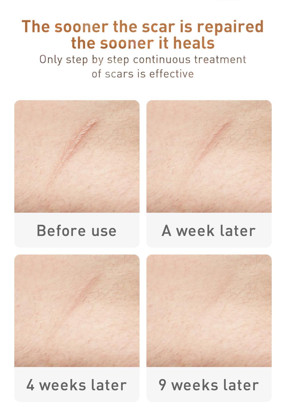 Crema pentru cicatrici, vergeturi, Lanbena